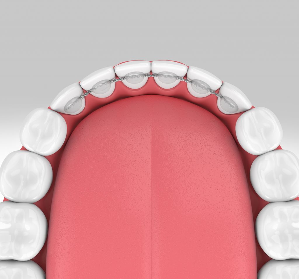 3D illustration of a bonded permanent retainer wire attached to the back of upper teeth