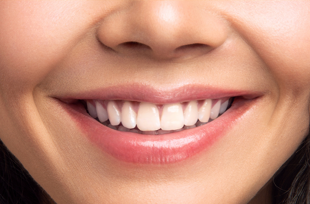 Close-up of a smiling woman showing bright white teeth after professional whitening treatment