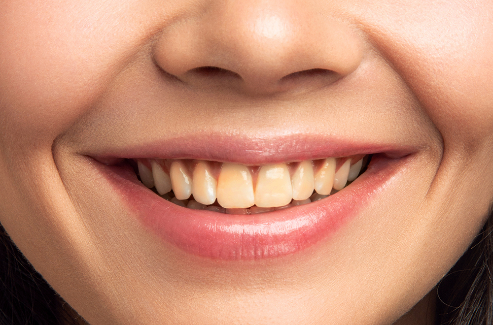 Close-up of a smiling woman showing discolored teeth before professional whitening treatment