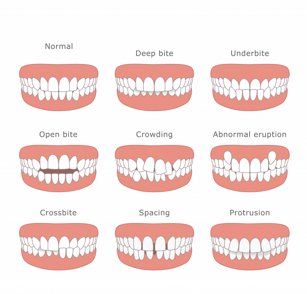 Diagram showing 9 types of dental malocclusion: Normal, Deep bite, Underbite, Open bite, Crowding, Abnormal eruption, Crossbite, Spacing, and Protrusion