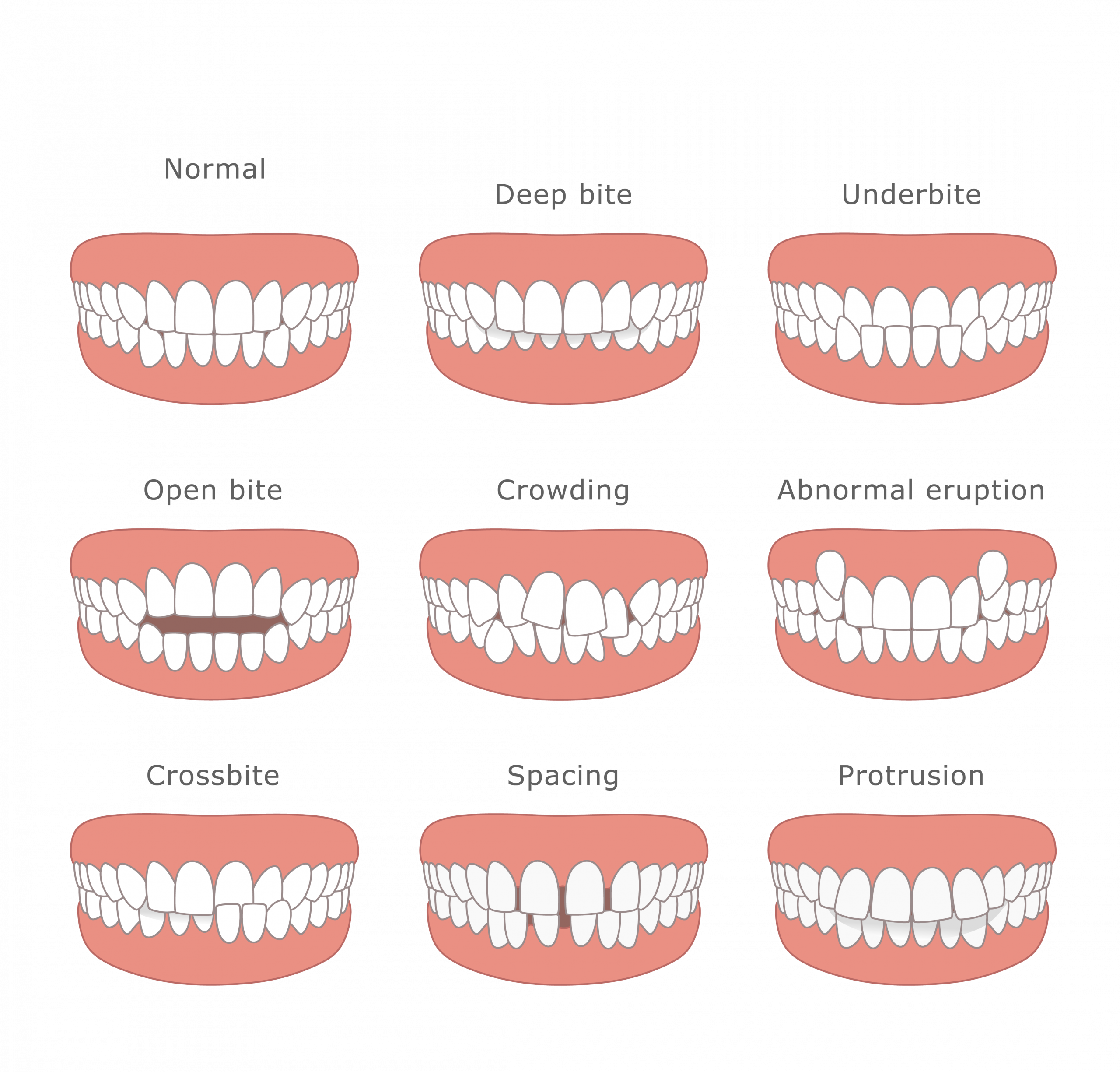 Diagram showing 9 types of dental malocclusion: Normal, Deep bite, Underbite, Open bite, Crowding, Abnormal eruption, Crossbite, Spacing, and Protrusion